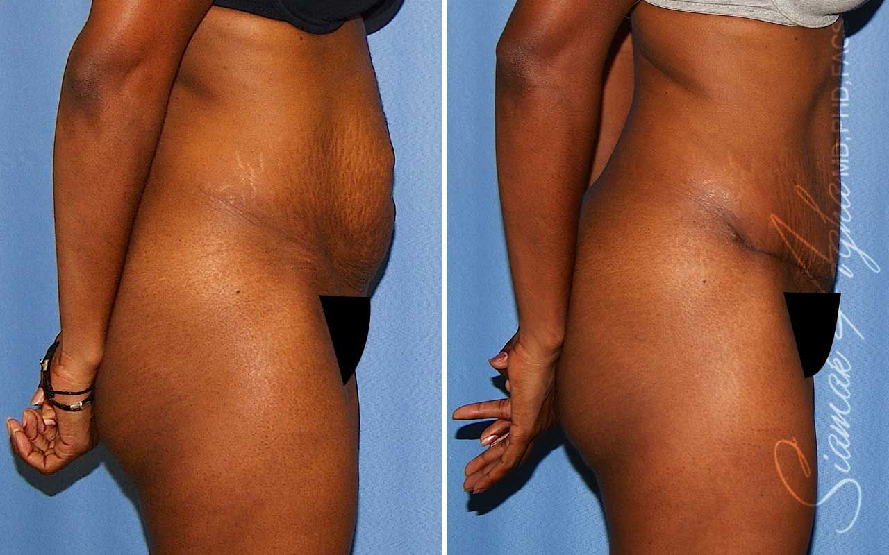 Tummy Tuck Before & After