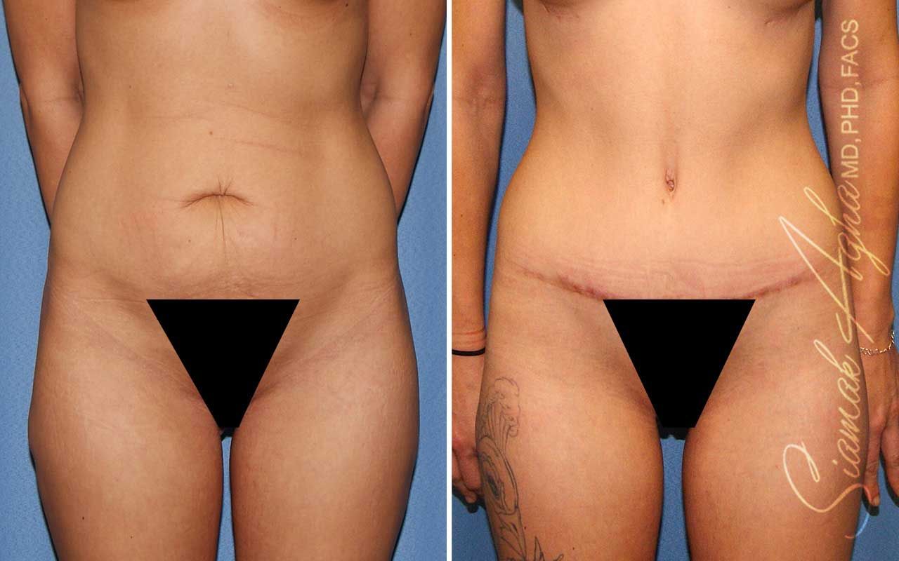 Tummy Tuck Before & After