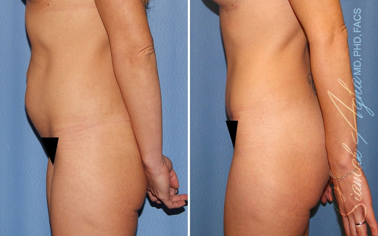 Tummy Tuck Before & After