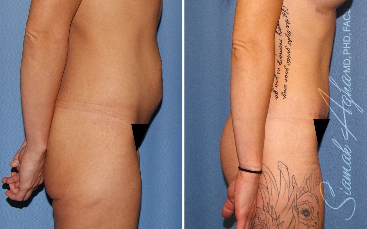 Tummy Tuck Before & After