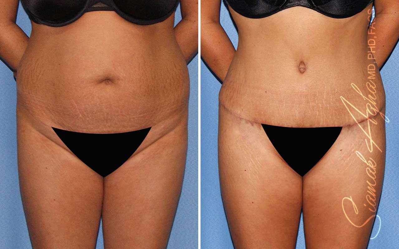 Tummy Tuck Before & After