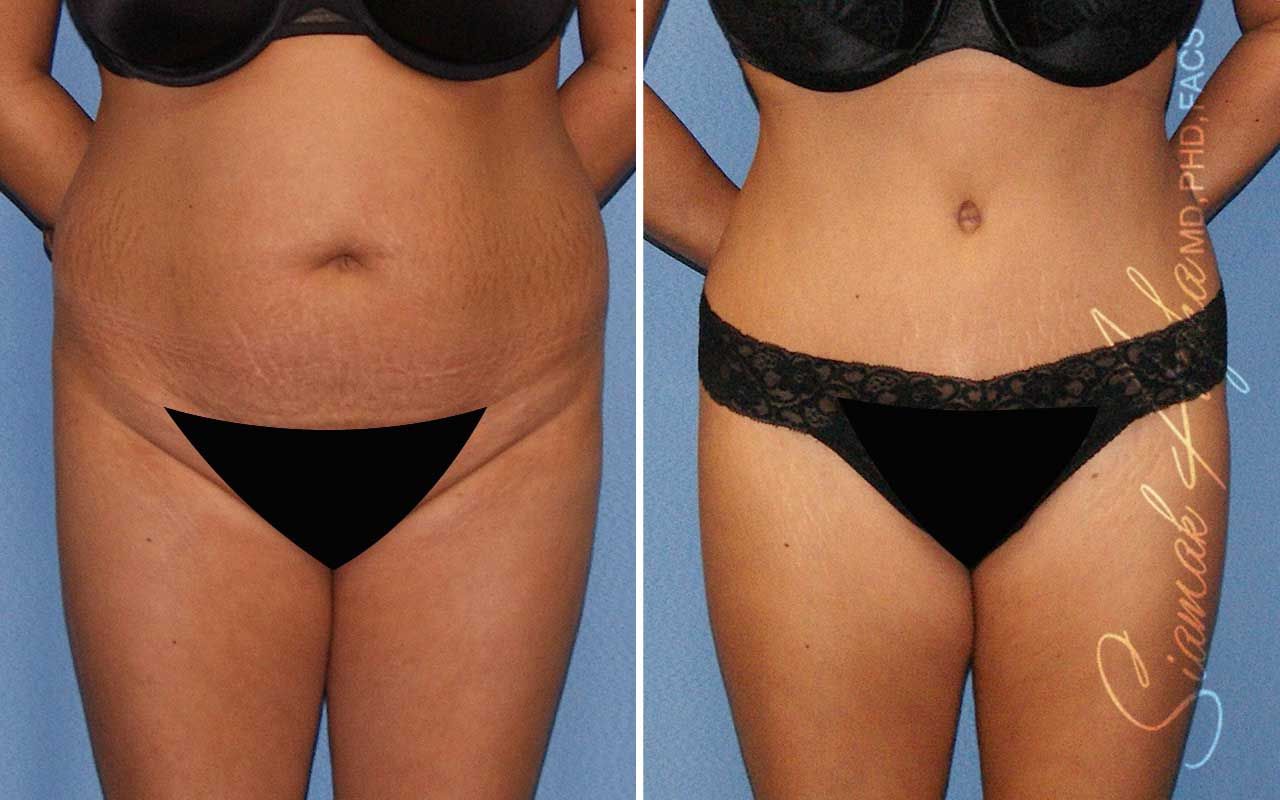 Tummy Tuck Before & After