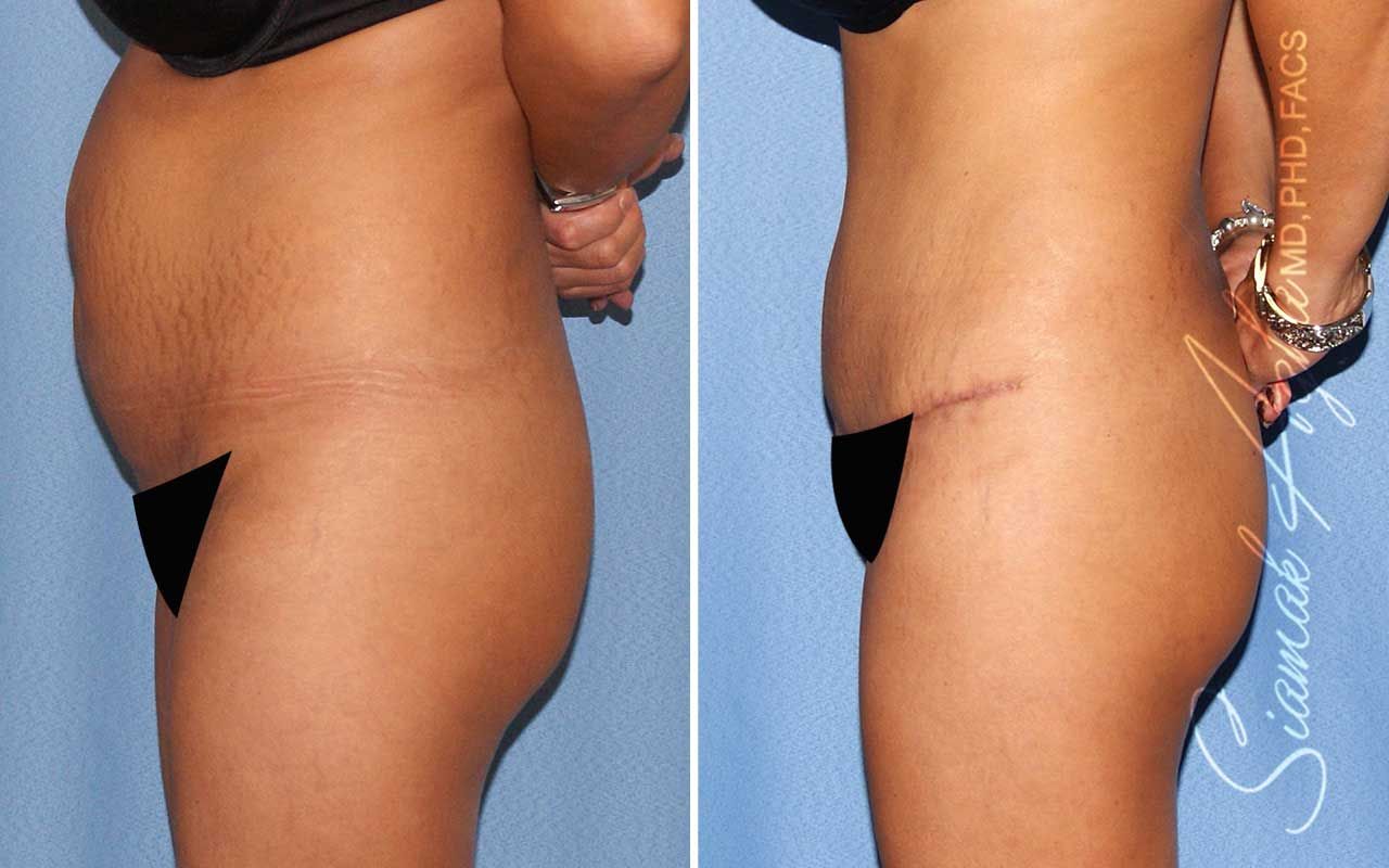 Tummy Tuck Before & After