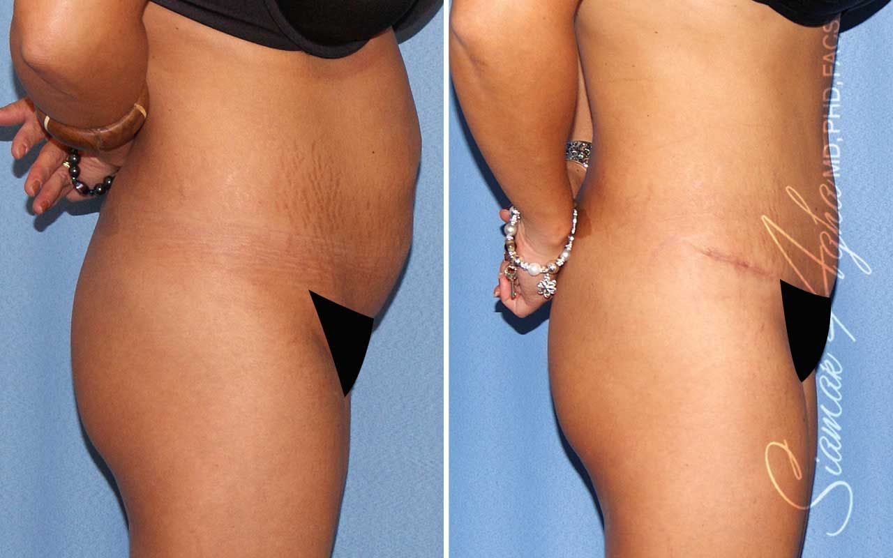 Tummy Tuck Before & After