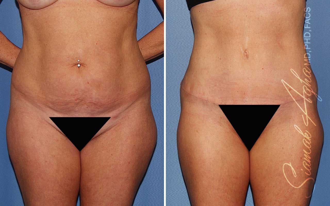 Tummy Tuck Before & After