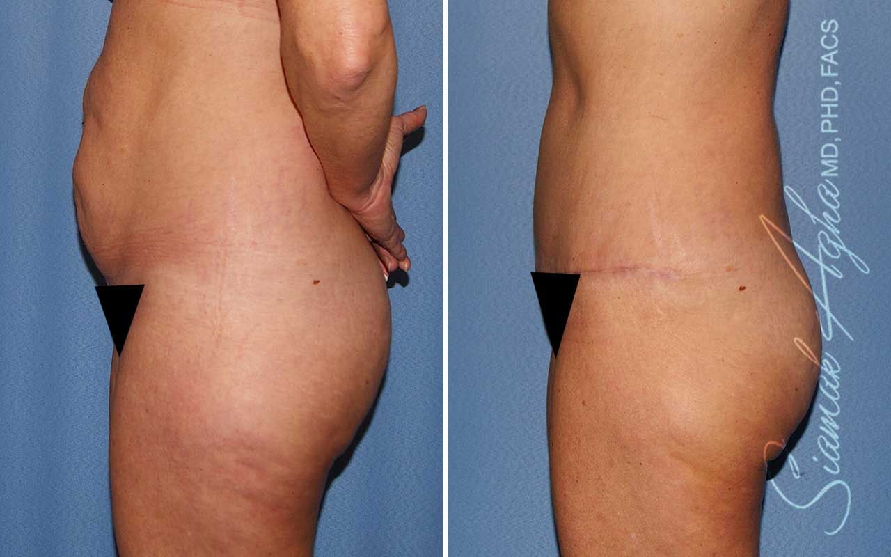 Tummy Tuck Before & After