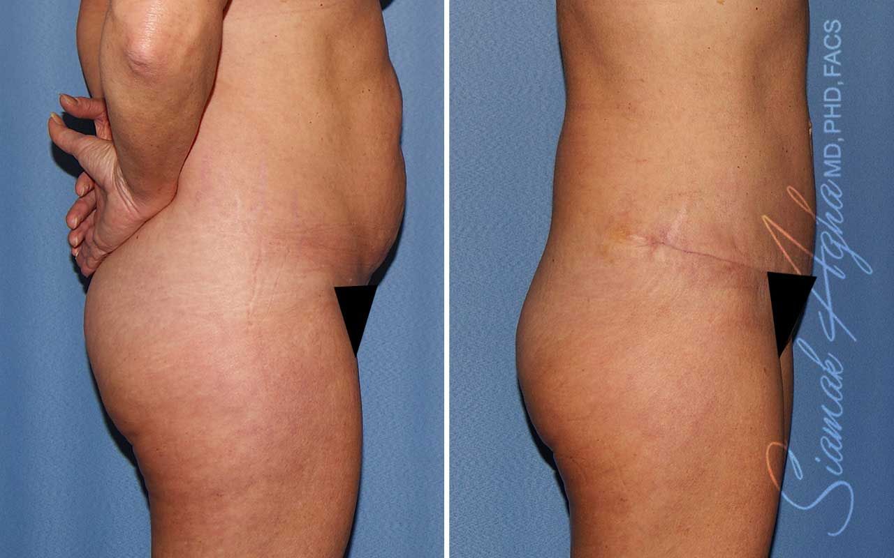 Tummy Tuck Before & After