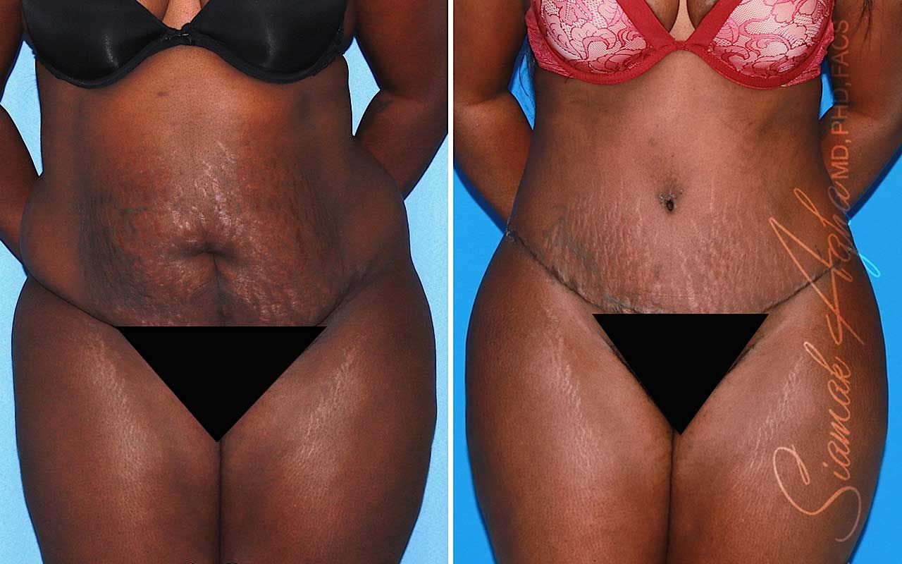 Tummy Tuck Before & After