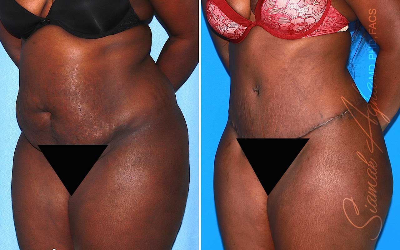 Tummy Tuck Before & After