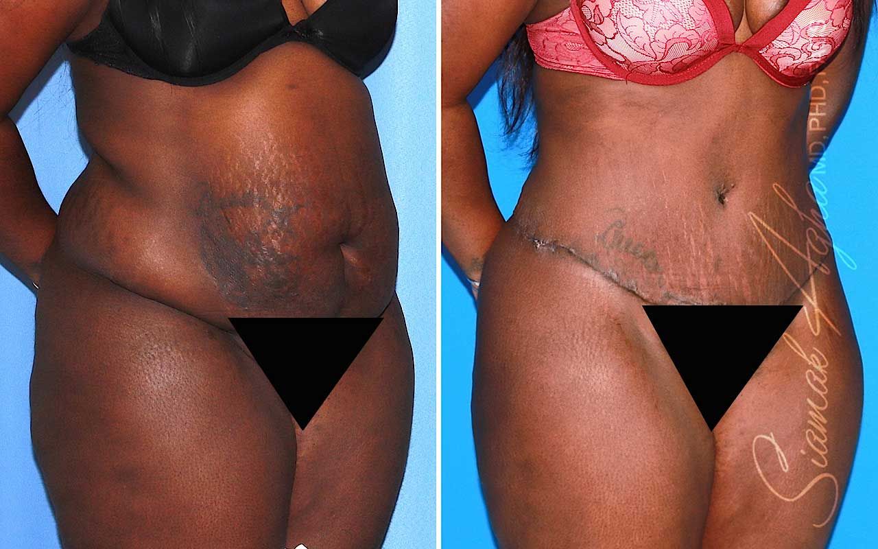 Tummy Tuck Before & After