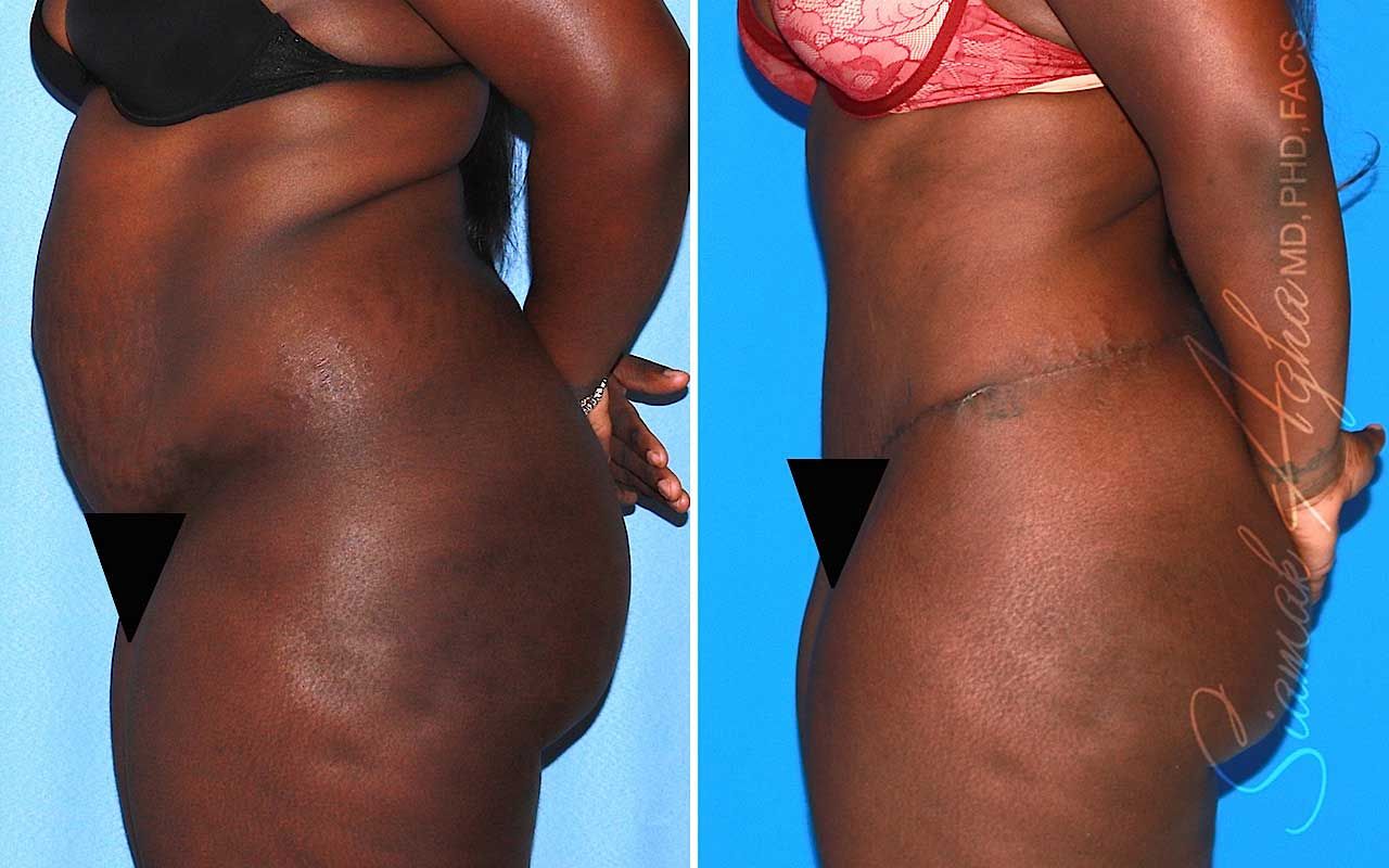 Tummy Tuck Before & After