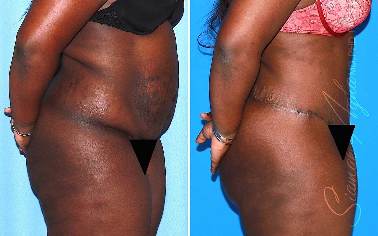 Tummy Tuck Before & After