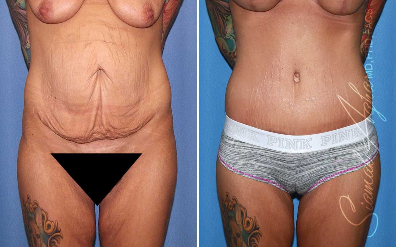 Tummy Tuck Before & After