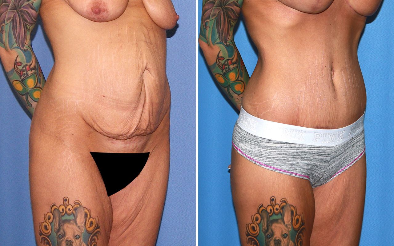 Tummy Tuck Before & After