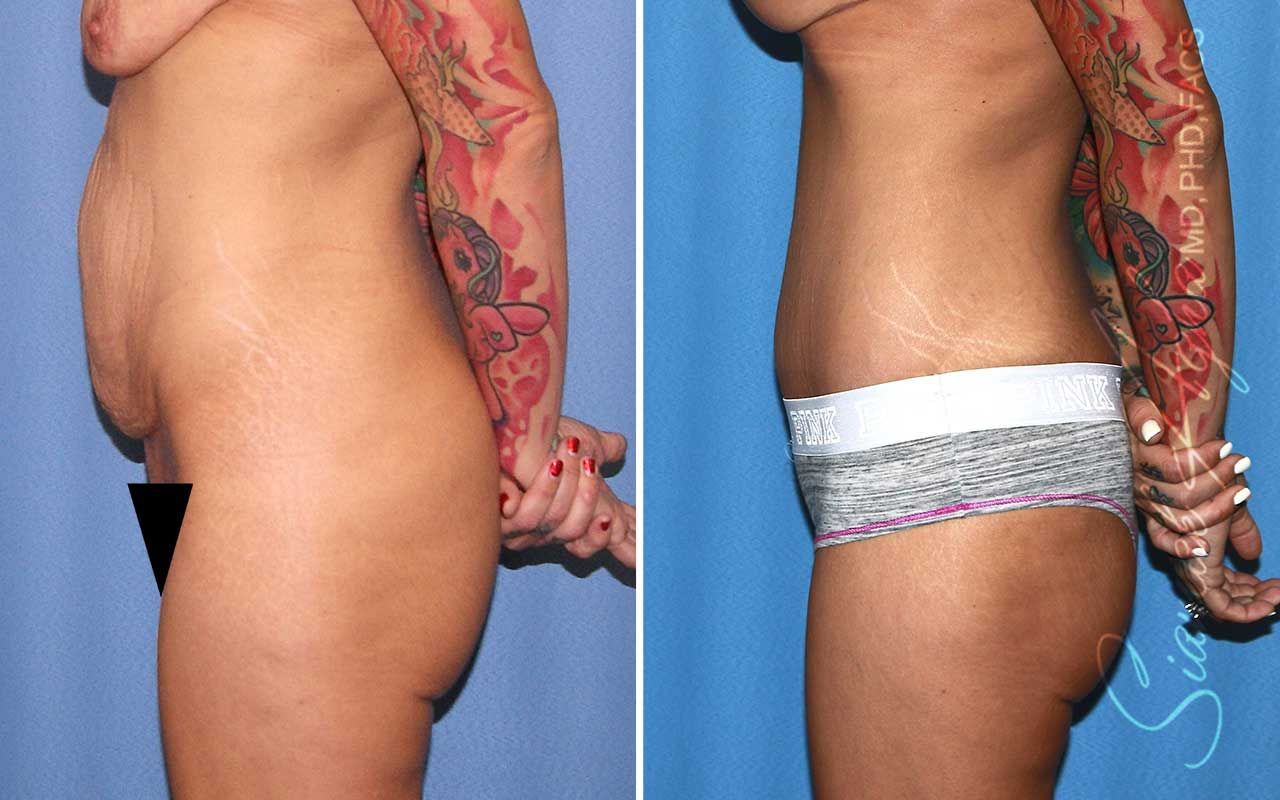 Tummy Tuck Before & After