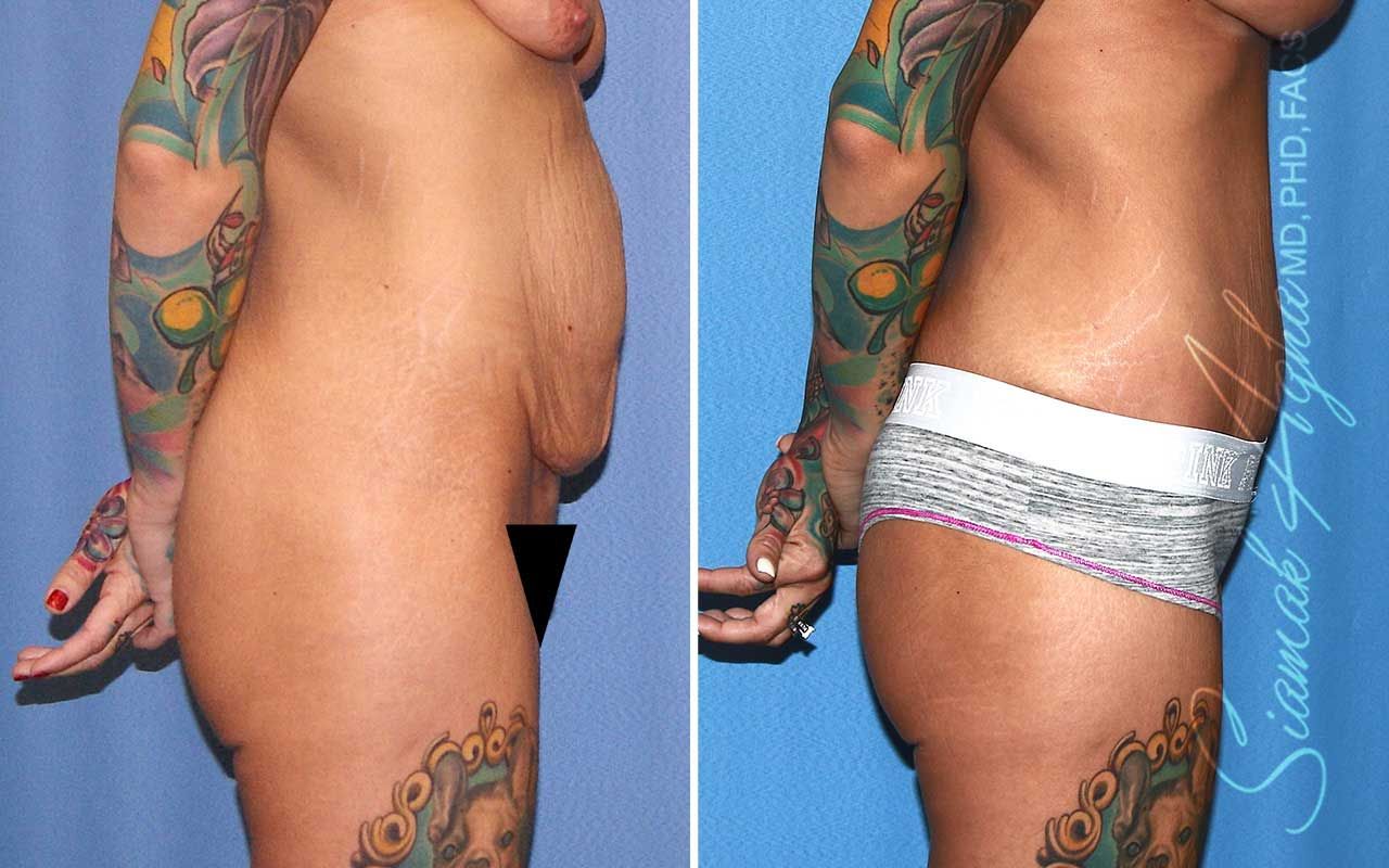 Tummy Tuck Before & After
