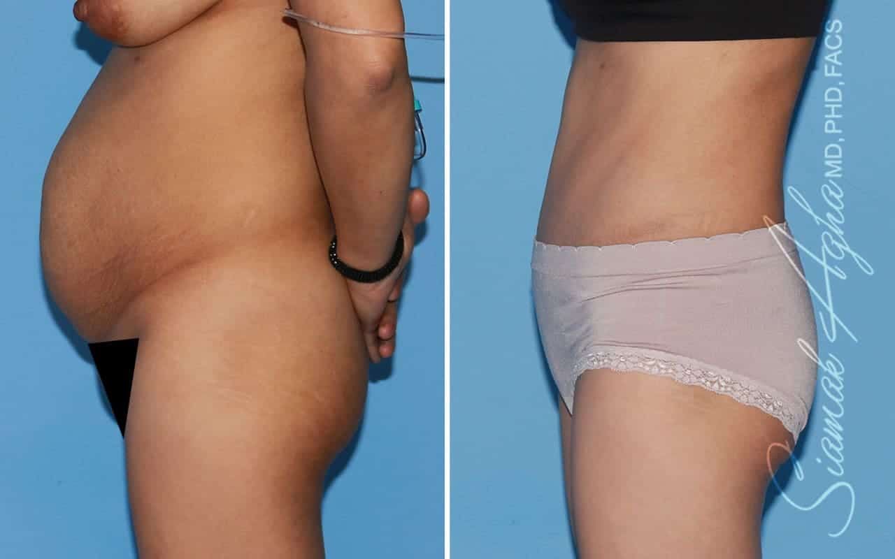 Tummy Tuck Before & After