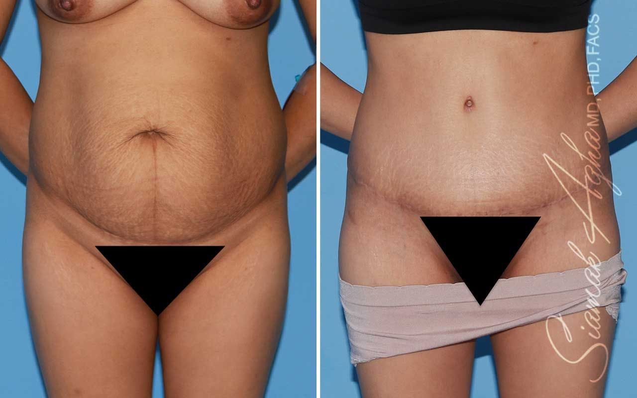 Tummy Tuck Before & After