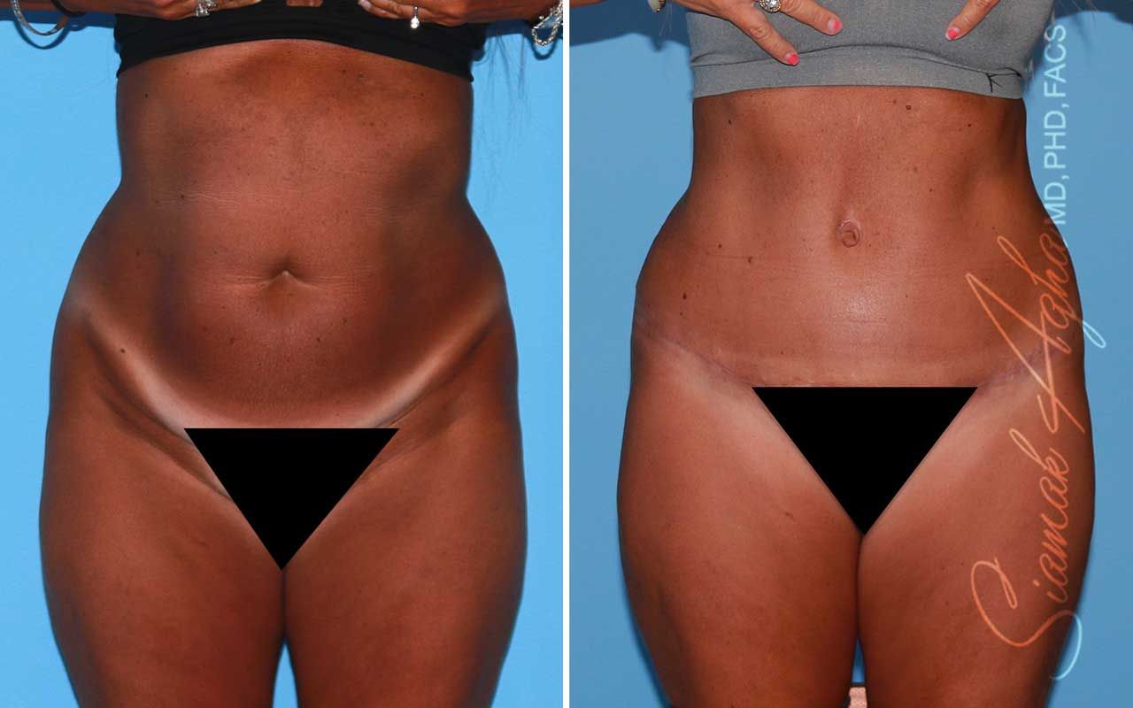 Tummy Tuck Before & After