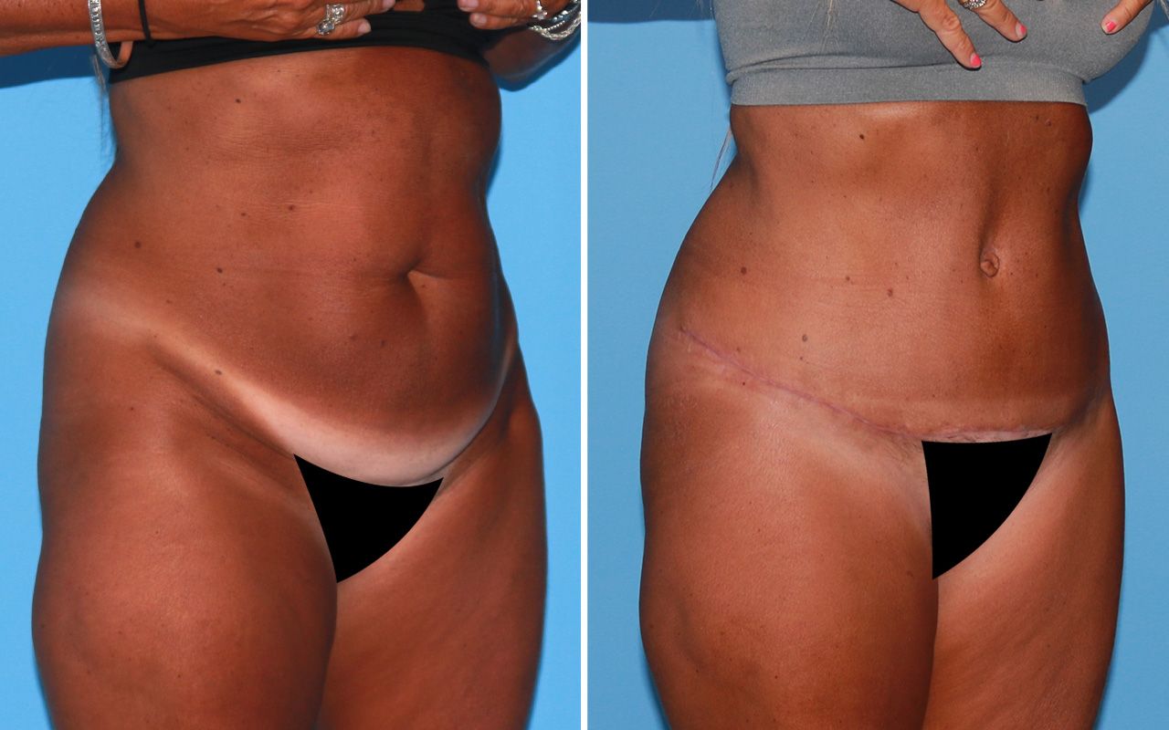 Tummy Tuck Before & After