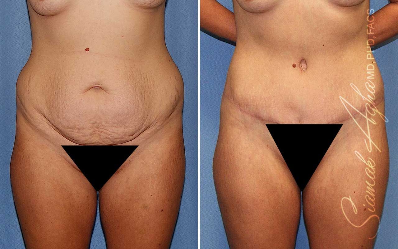 Tummy Tuck Before & After