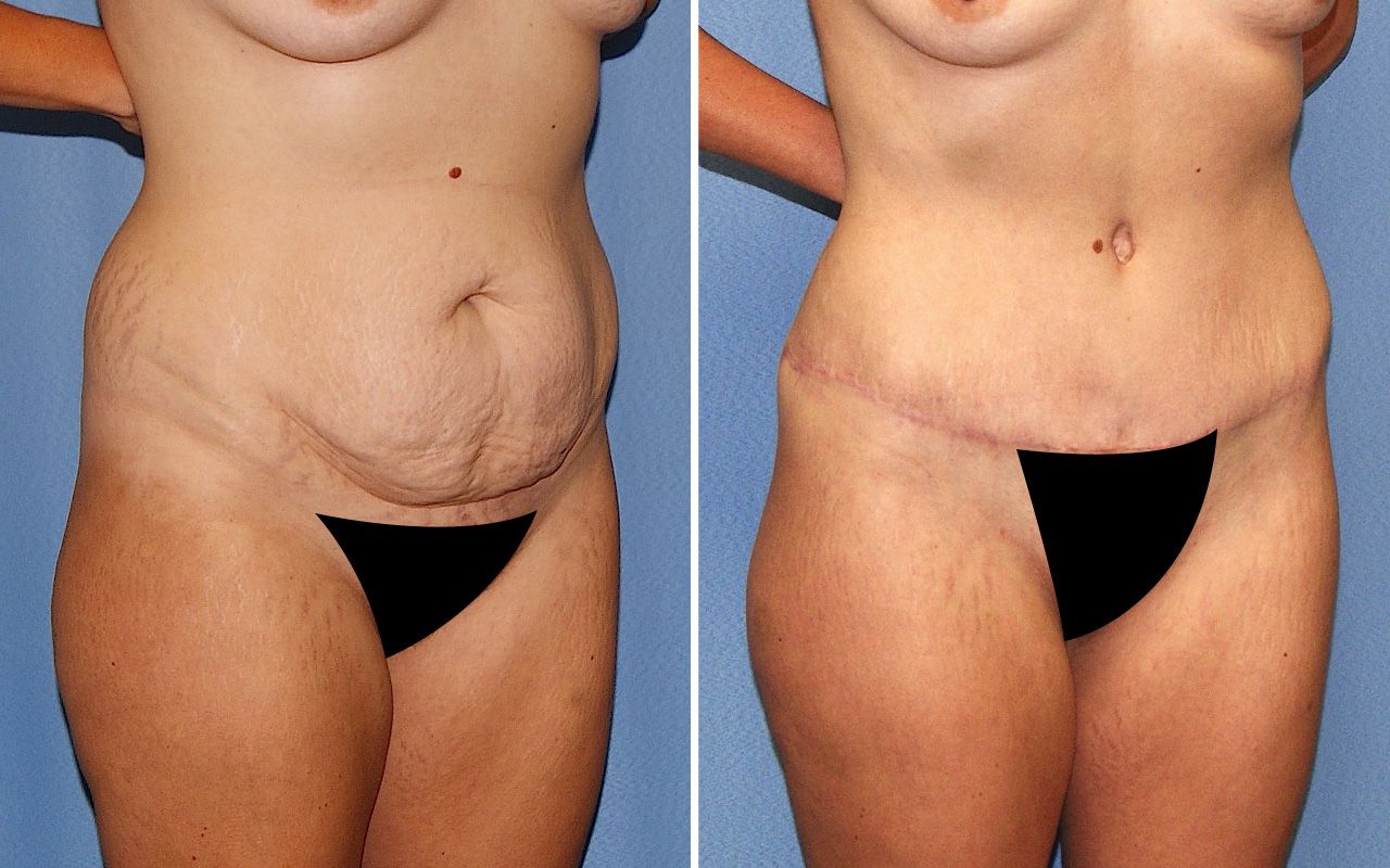 Tummy Tuck Before & After