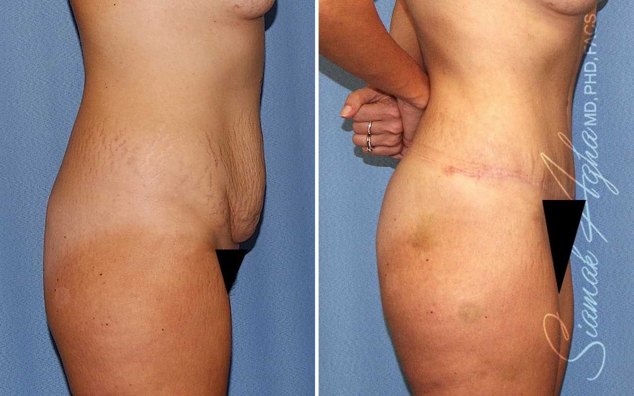 Tummy Tuck Before & After