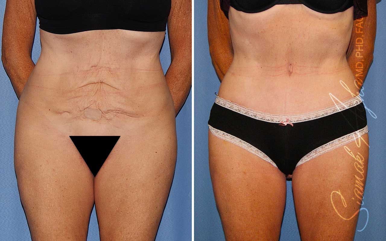 Tummy Tuck Before & After