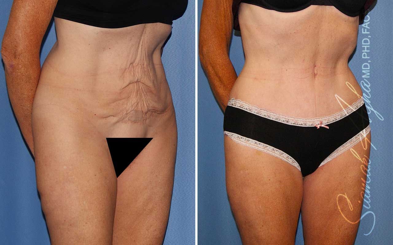 Tummy Tuck Before & After