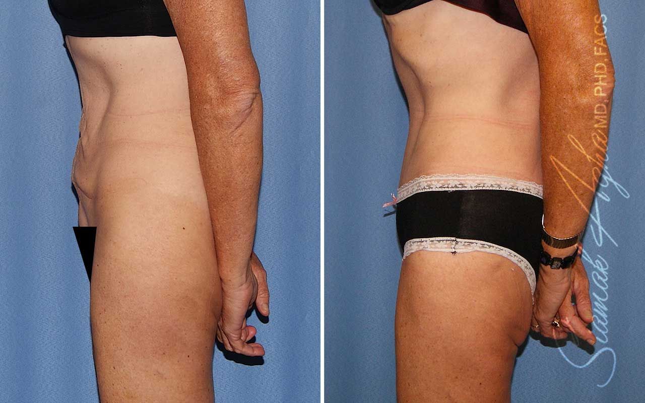 Tummy Tuck Before & After