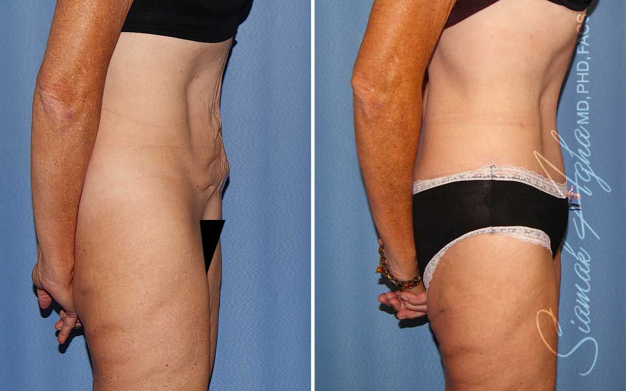 Tummy Tuck Before & After