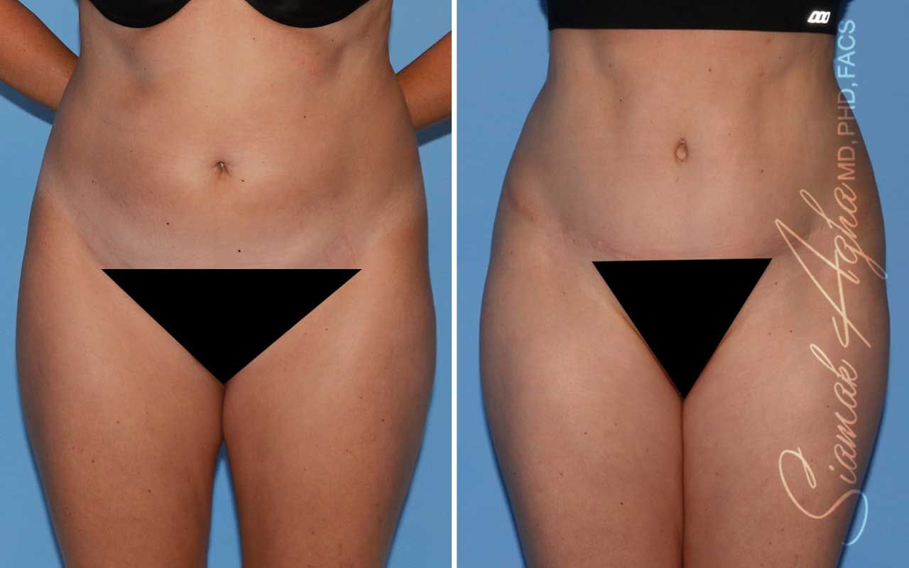 Tummy Tuck Before & After
