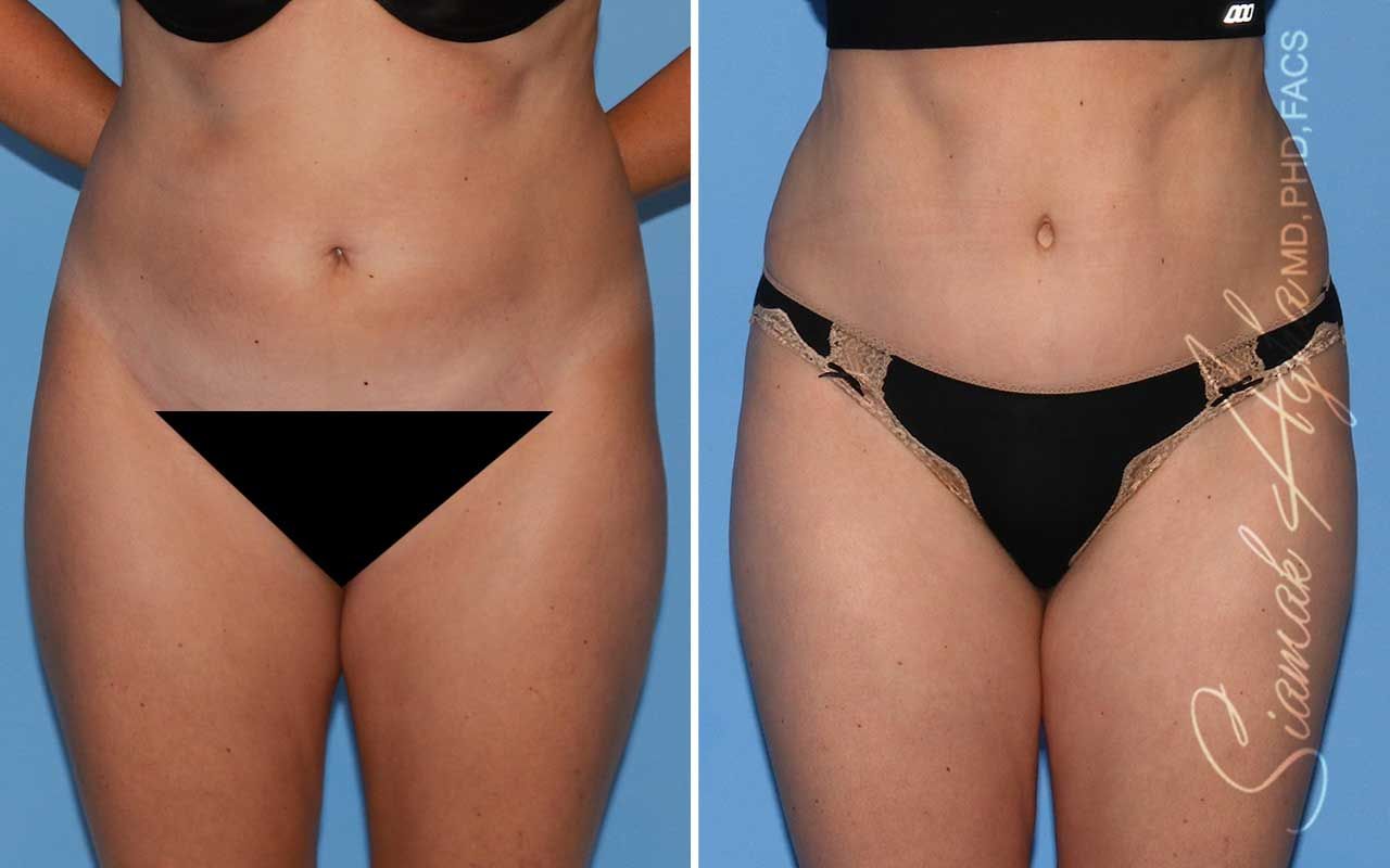 Tummy Tuck Before & After