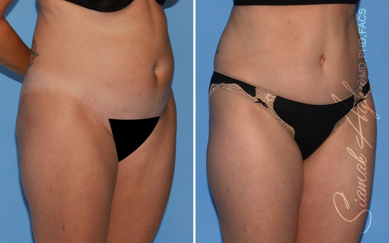 Tummy Tuck Before & After