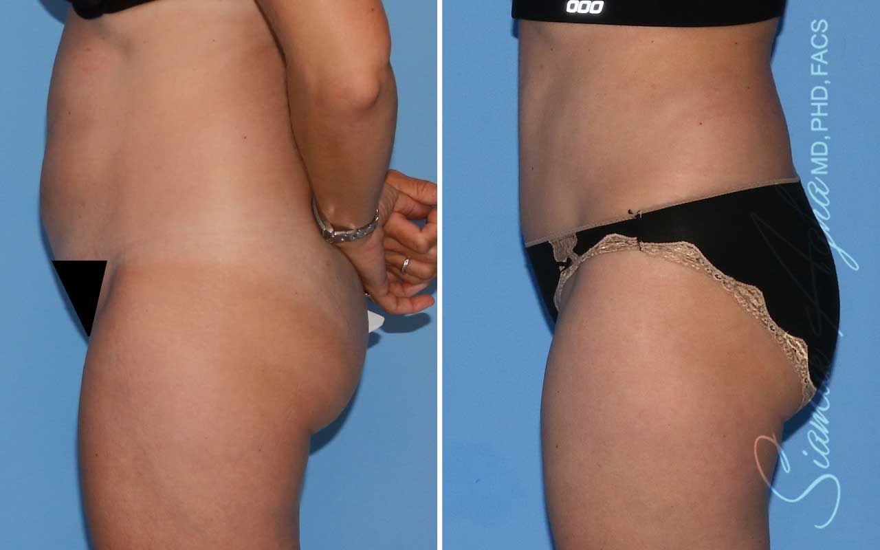 Tummy Tuck Before & After