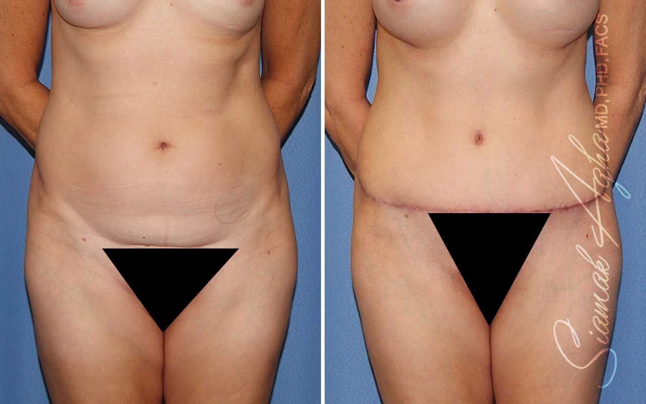Tummy Tuck Before & After