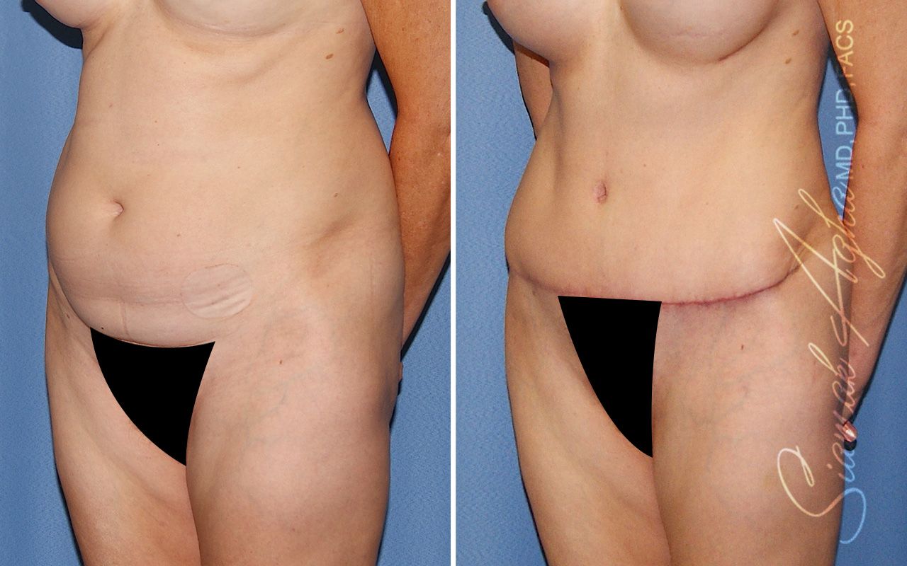 Tummy Tuck Before & After