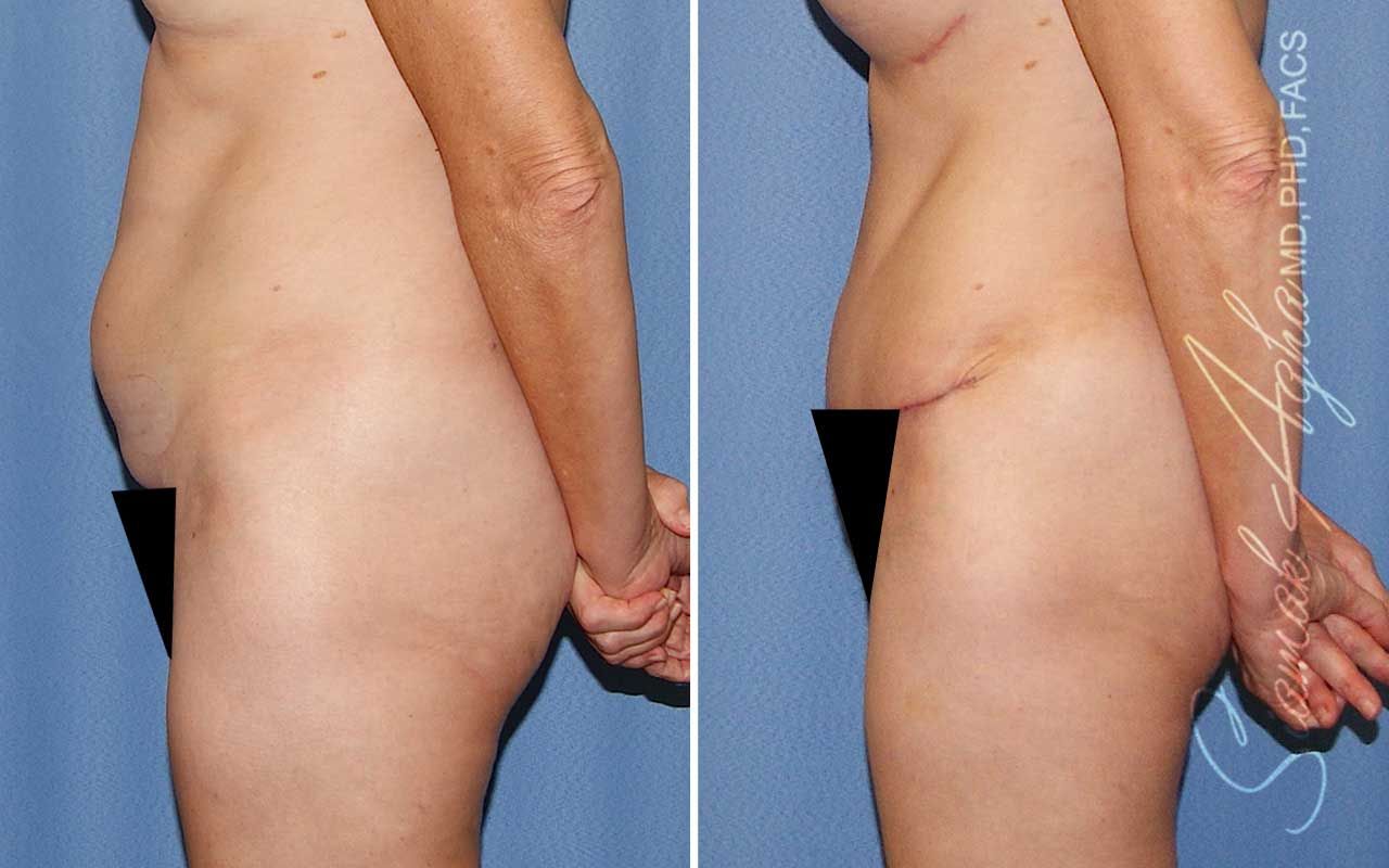 Tummy Tuck Before & After