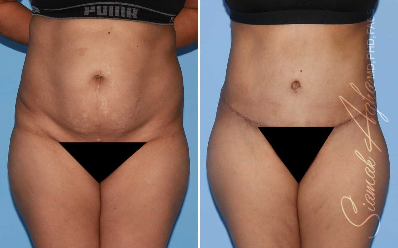 Tummy Tuck Before & After