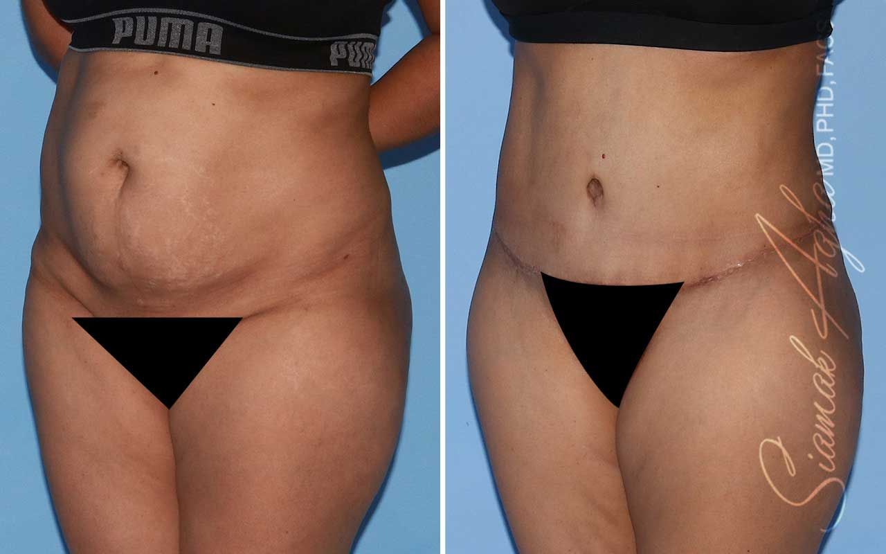 Tummy Tuck Before & After