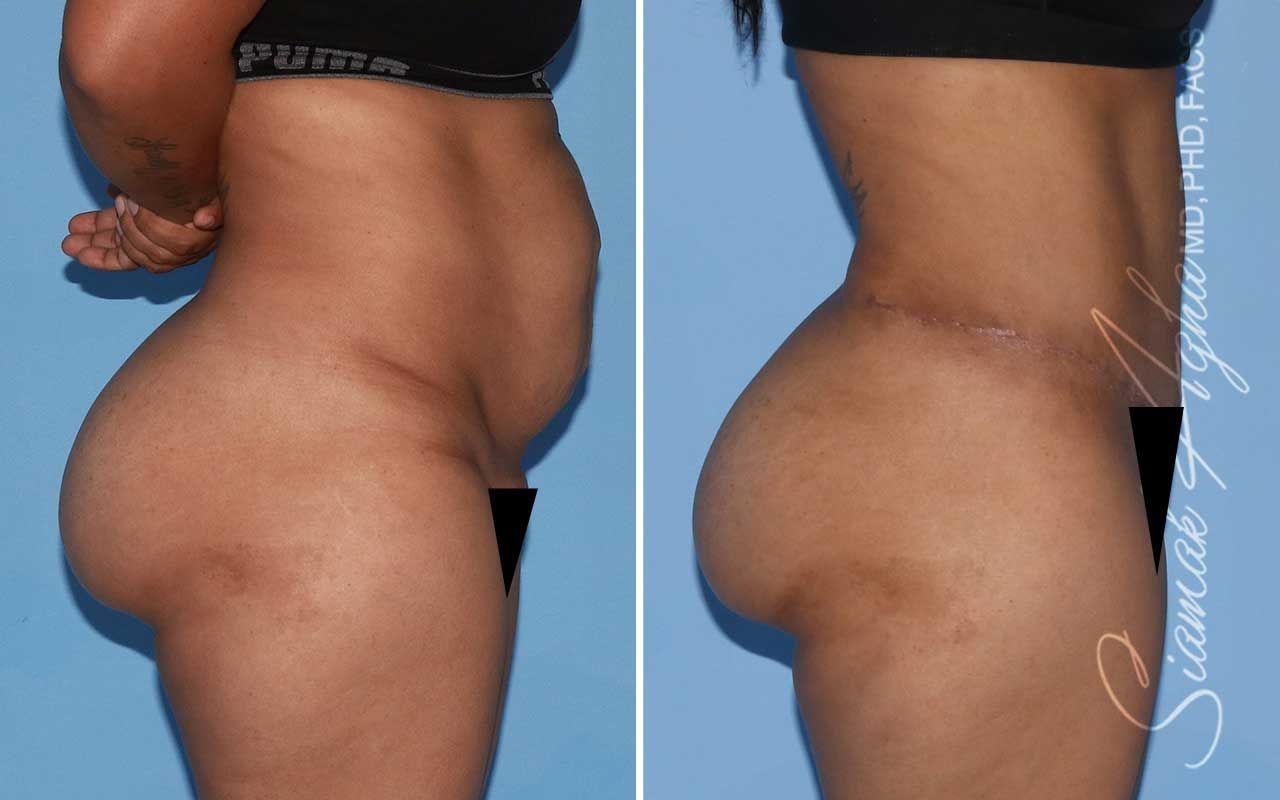 Tummy Tuck Before & After