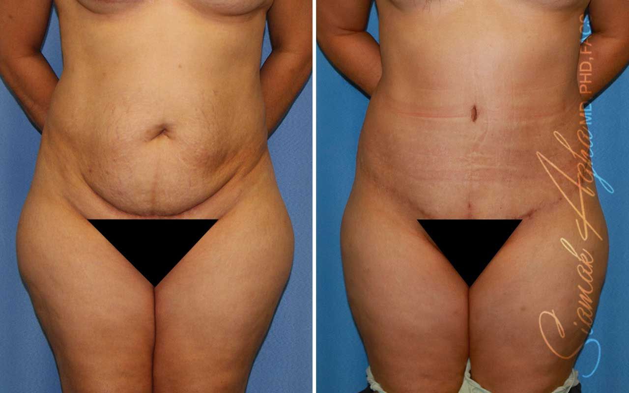Tummy Tuck Before & After