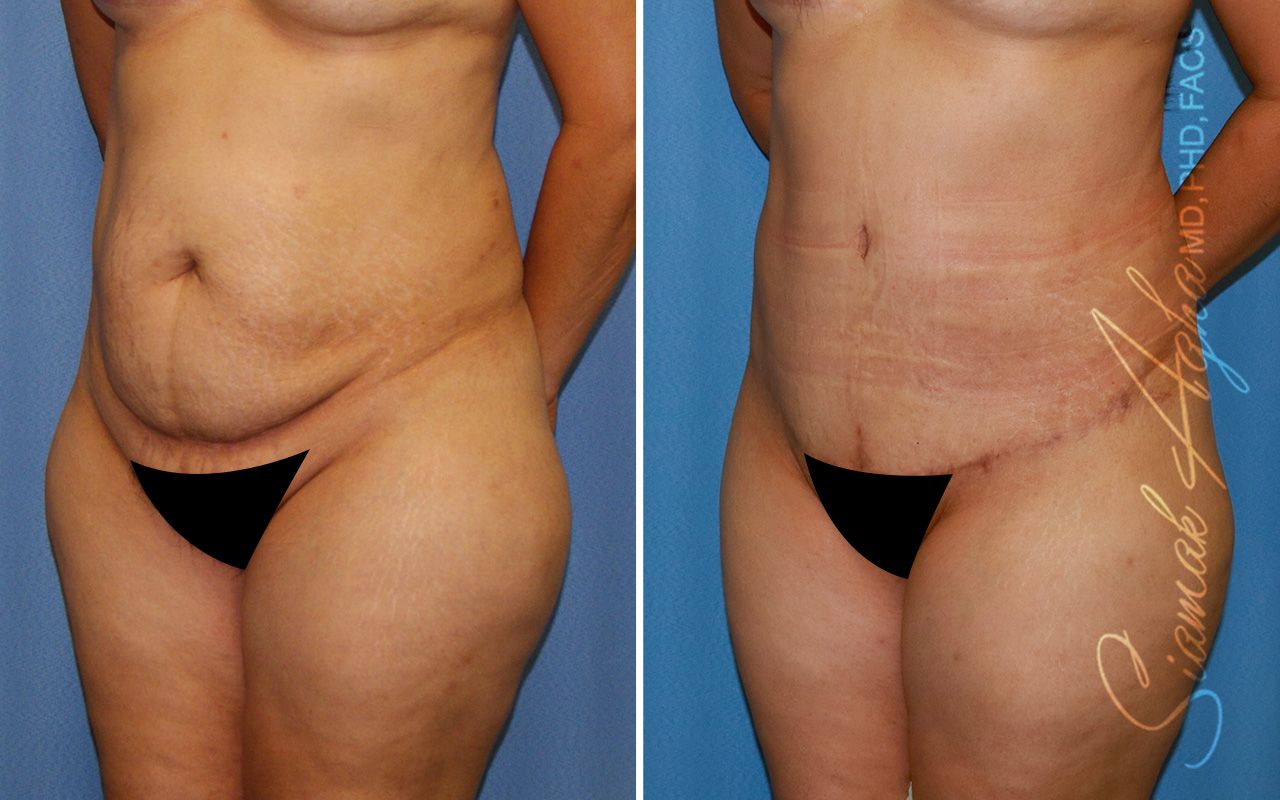 Tummy Tuck Before & After
