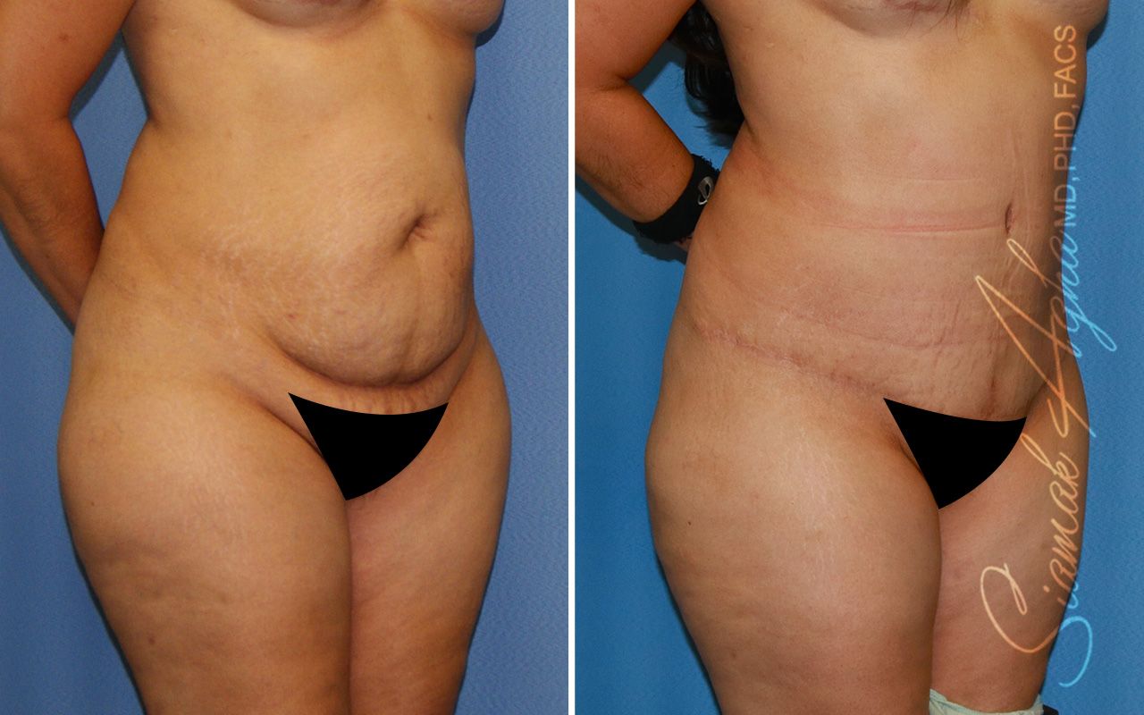 Tummy Tuck Before & After