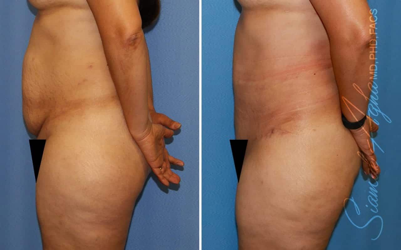 Tummy Tuck Before & After