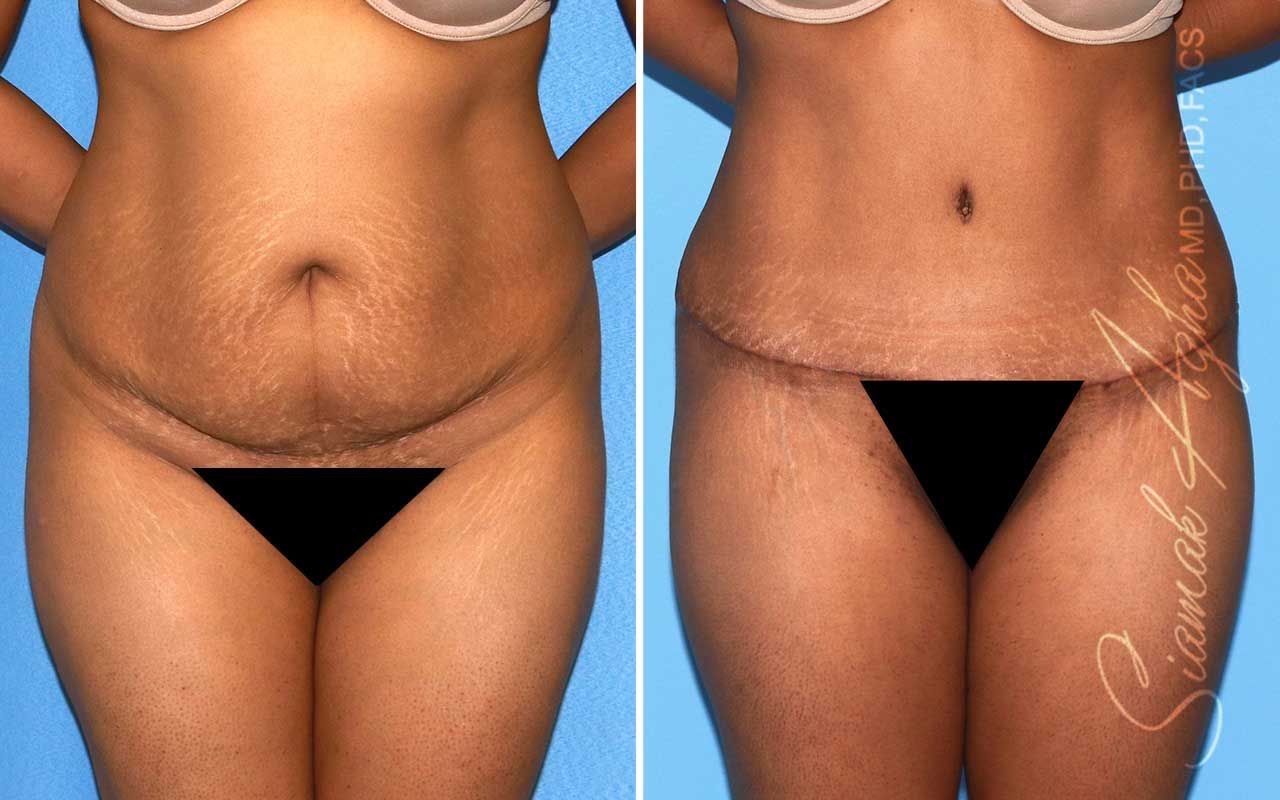 Tummy Tuck Before & After