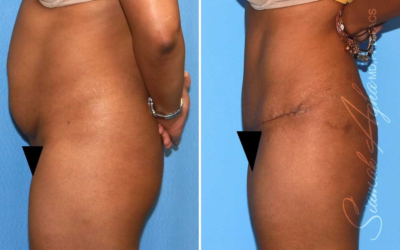 Tummy Tuck Before & After