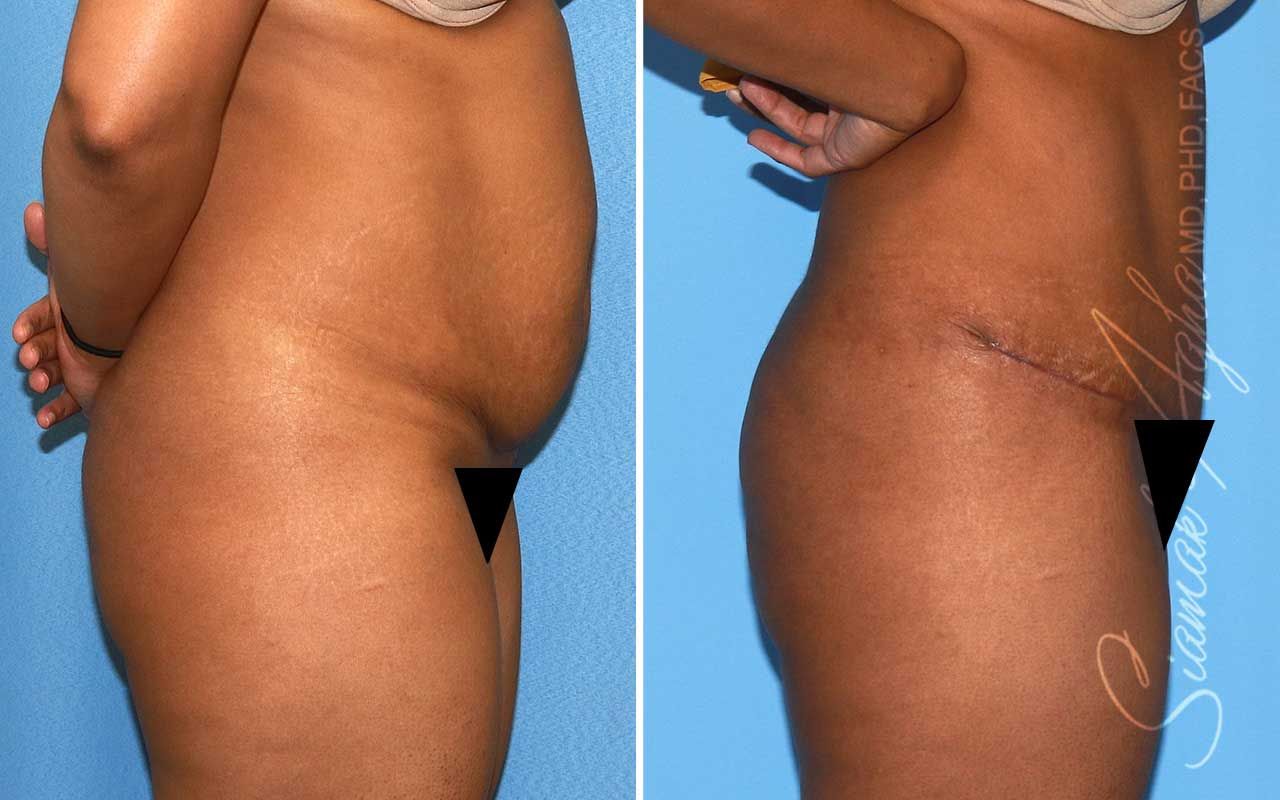 Tummy Tuck Before & After