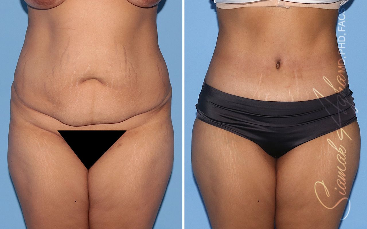 Tummy Tuck Before & After
