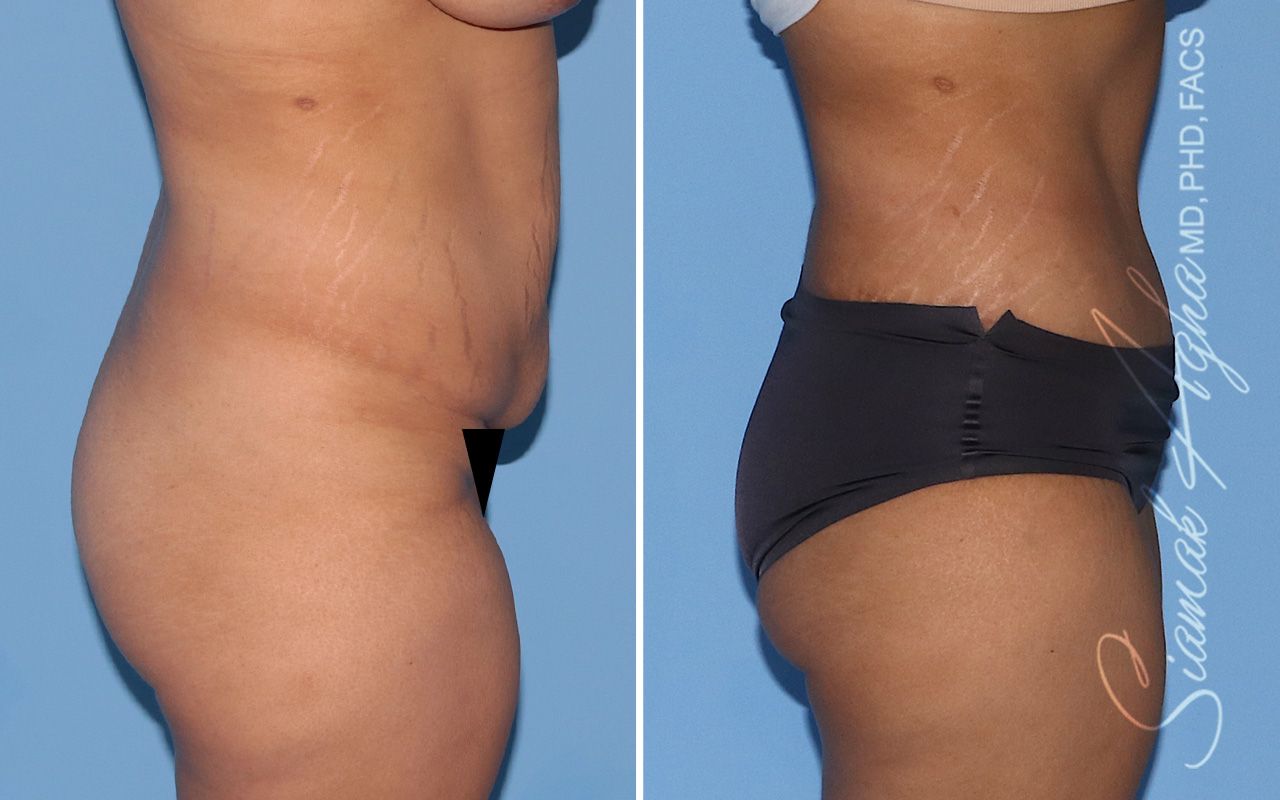 Tummy Tuck Before & After